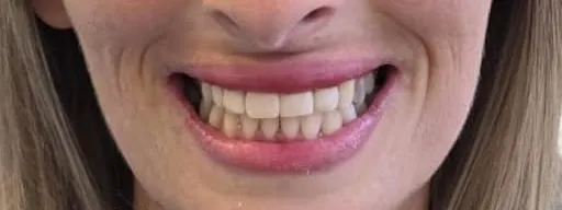 Dopo: denti allineati e restaurati in un sorriso naturale