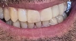 Dopo: denti regolari e restaurati
