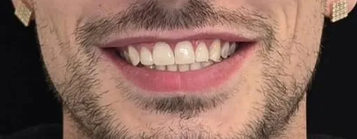 Dopo: denti frontali uniformi e senza spazi, ricostruiti in composito